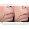 Extra Strength Active Peel Brightening System